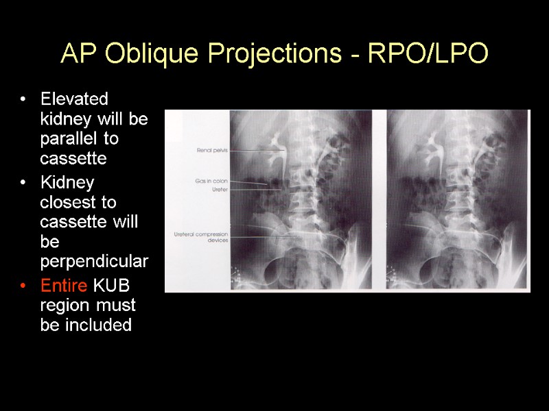 AP Oblique Projections - RPO/LPO Elevated kidney will be parallel to cassette Kidney closest